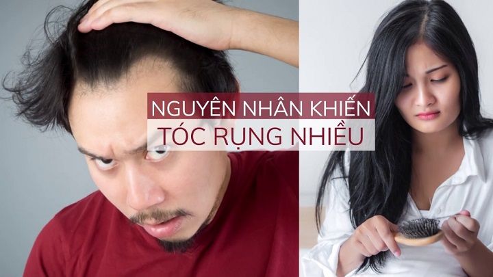 GIẢI TOẢ NỖI LO RỤNG TÓC – CÁCH CHỮA RỤNG TÓC HIỆU QUẢ GIẢI TOẢ NỖI LO RỤNG TÓC – CÁCH CHỮA RỤNG TÓC HIỆU QUẢ
