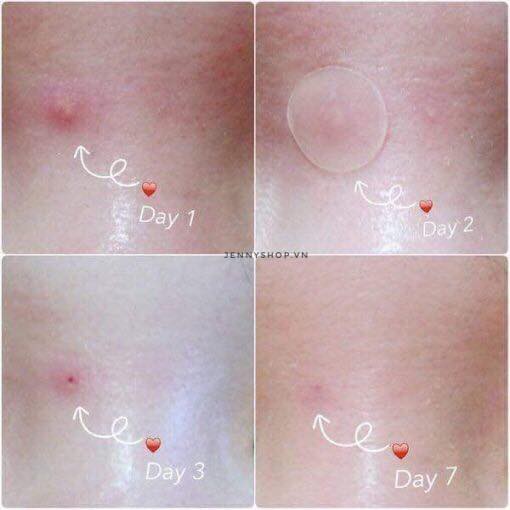 Dán Trị Mụn Ciracle Red Spot Acne Pimple Path