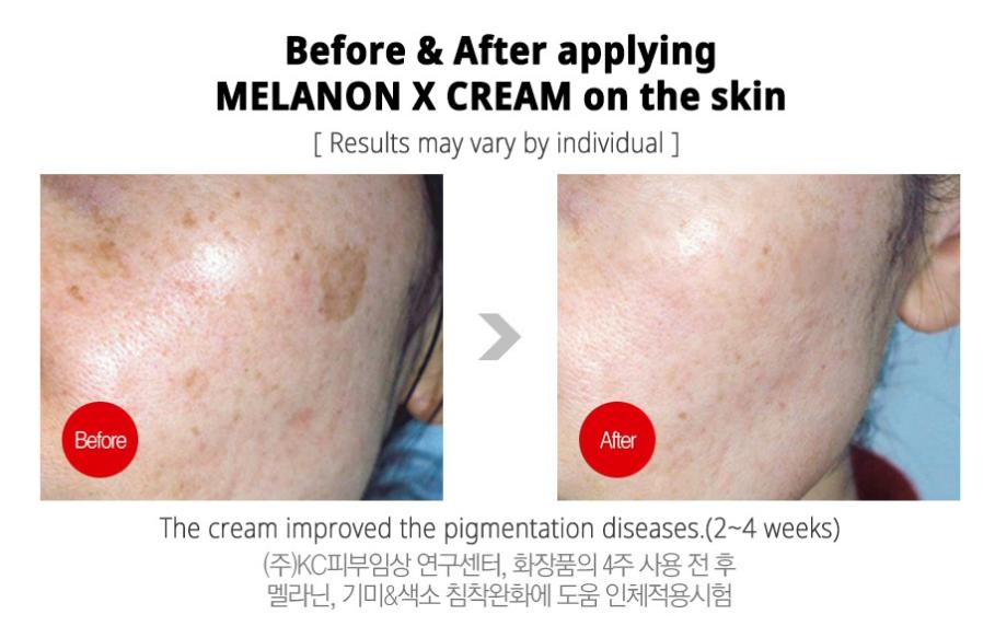 Kem trị thâm nám và tàn nhang Medi Peel Melanon X Cream 30ml