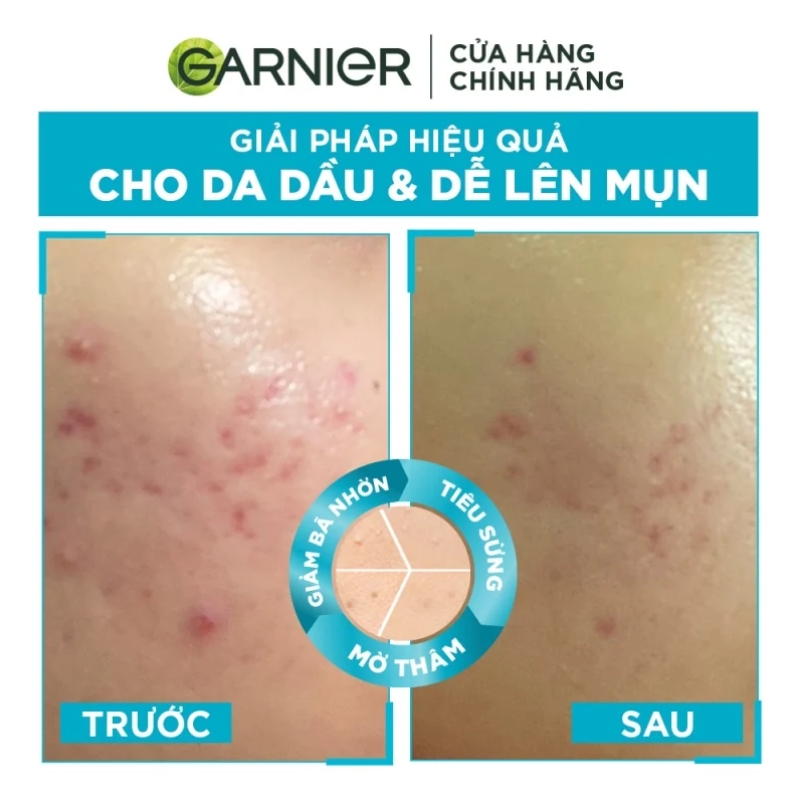 Tinh Chất Garnier Giảm Mụn Mờ Thâm Cho Da Dầu Bright Anti-Acne Booster 30ml (Mẫu Mới)