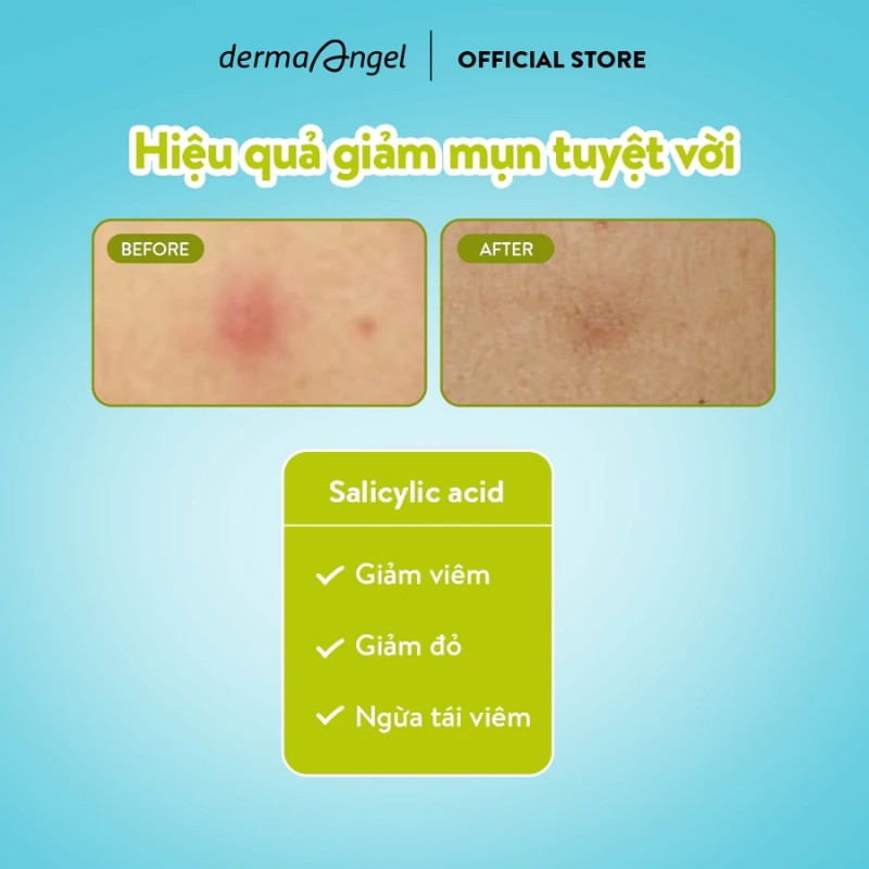 Miếng Dán Mụn Ban Ngày Derma Angel Acne Patch Plus With Salicylic Acid Clearing (12 Miếng)