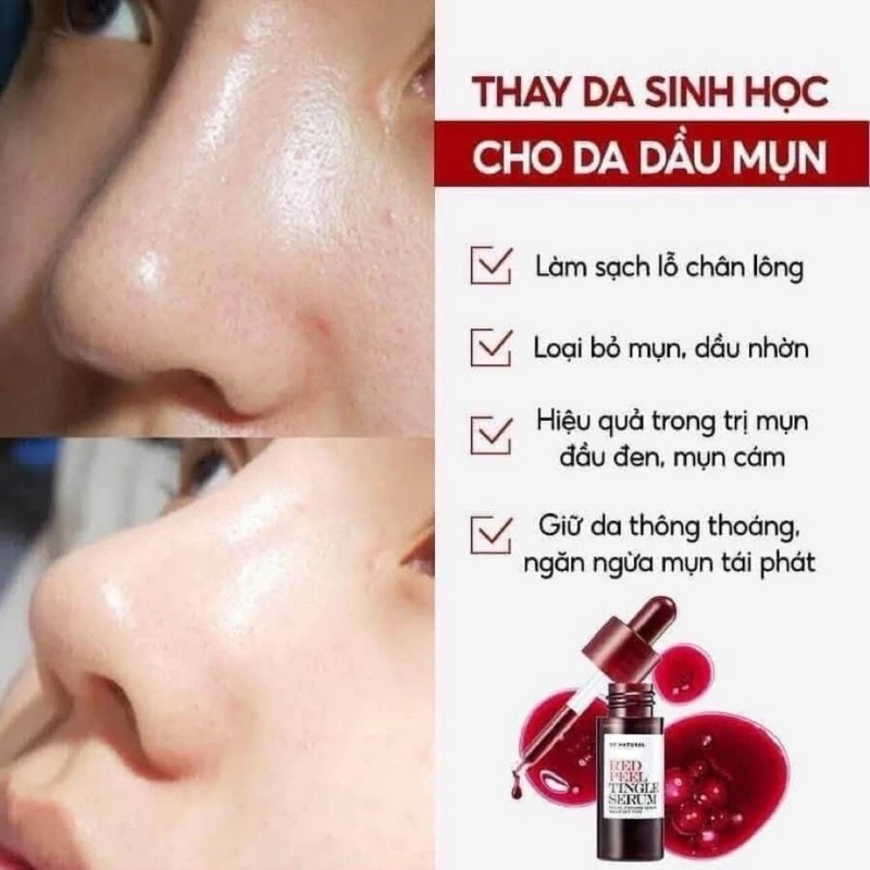 Tinh Chất Tái Tạo Da So Natural Red Peel Tingle Serum Facial Peeling