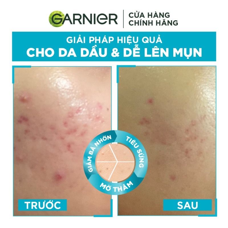 Tinh Chất Garnier Giảm Mụn Mờ Thâm Cho Da Dầu Bright Complete Anti-Acne Booster Serum 30ml