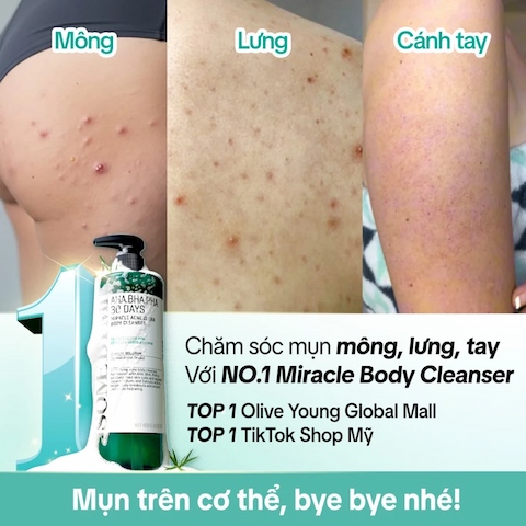 Sữa Tắm Giảm Mụn Some By Mi AHA-BHA-PHA 30 Days Miracle Acne 400g