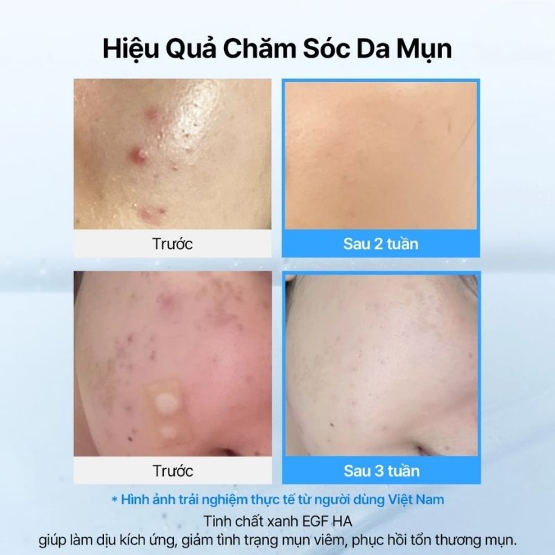 Tinh Chất Klairs EGF Blue AC Calming 50g