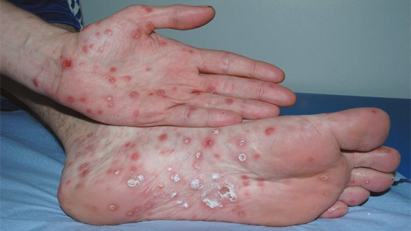 Những hiểu biết cơ bản về  bệnh Giang mai – Syphilis