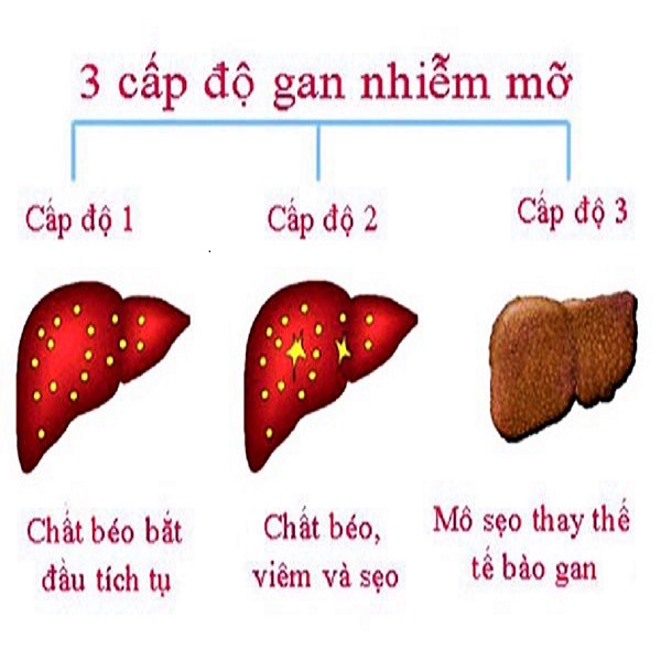 Bệnh gan nhiễm mỡ độ 2 – Nguyên nhân, triệu chứng và cách điều trị