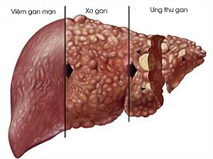 Fudteno thuốc điều trị viêm gan B tốt nhất