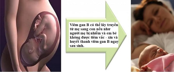 Hiểu rõ hơn lây truyền viêm gan B từ mẹ sang con