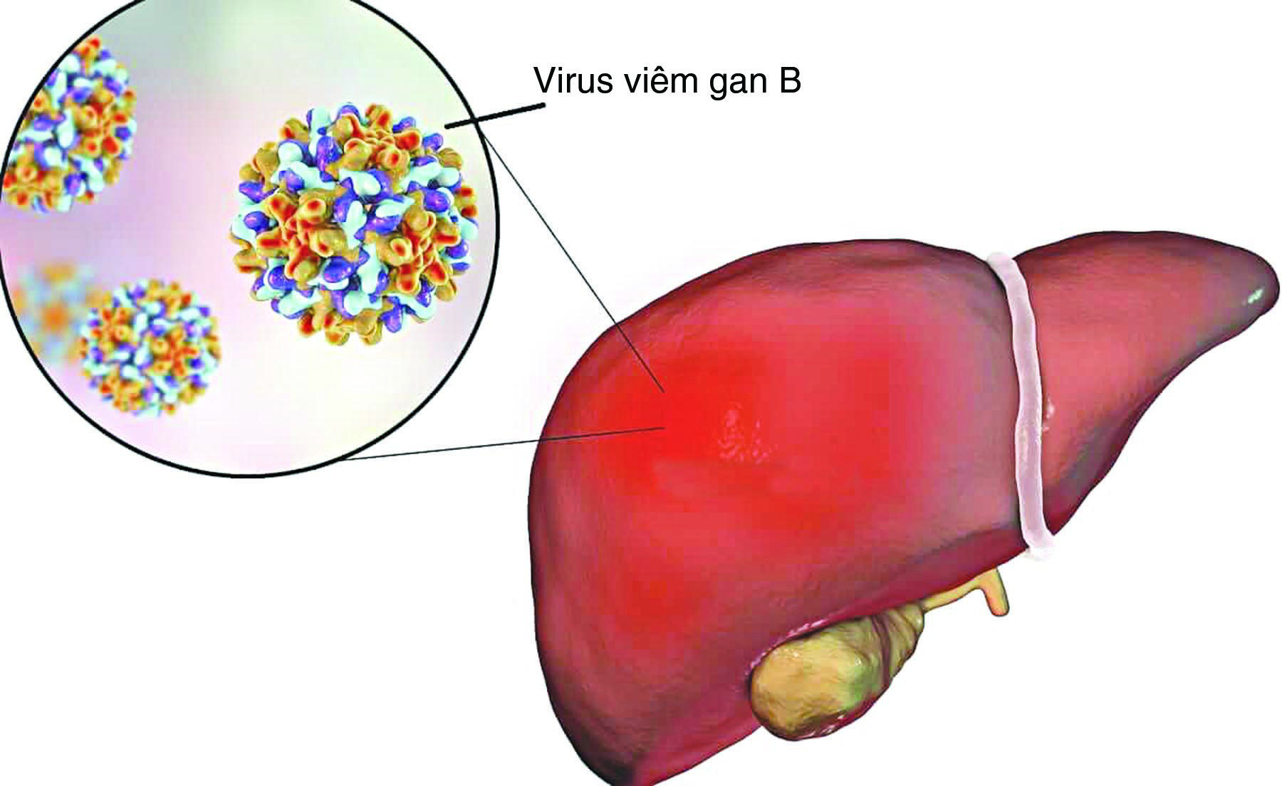 10 câu hỏi thường gặp về viêm gan B