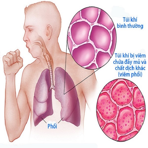 Bệnh viêm phổi: nguyên nhân từ đâu, triệu chứng, chẩn đoán và điều trị
