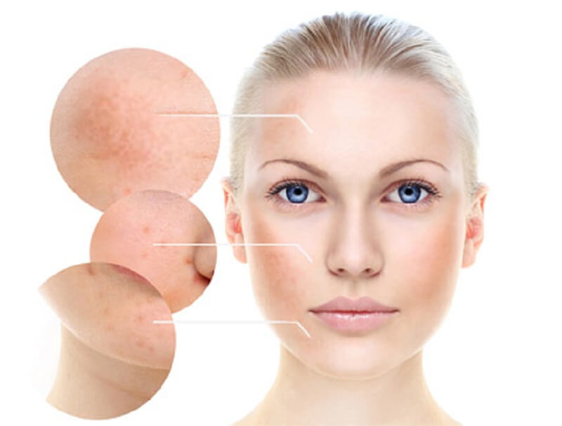 Trị nám bằng Laser ở đâu tốt nhất?