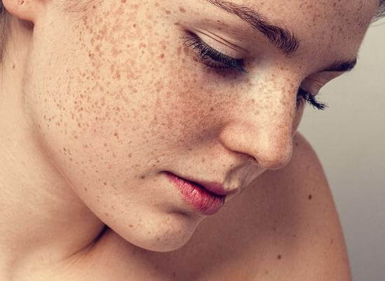 Nám da mặt lâu năm có cách nào chữa tận gốc được không?