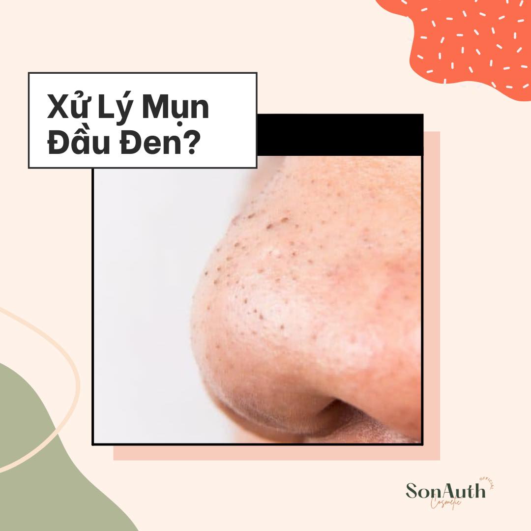 SkinCare101: Trị Mụn Đầu Đen - Bài Toán Khó Hay Dễ?