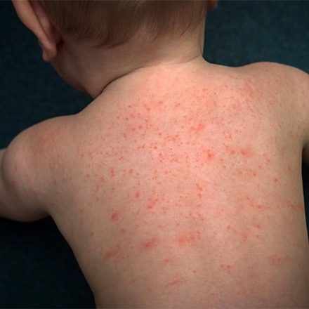 Nhận biết các dấu hiệu mẩn đỏ trên da trẻ sơ sinh