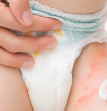 Phân biệt dị ứng bỉm và hăm bỉm