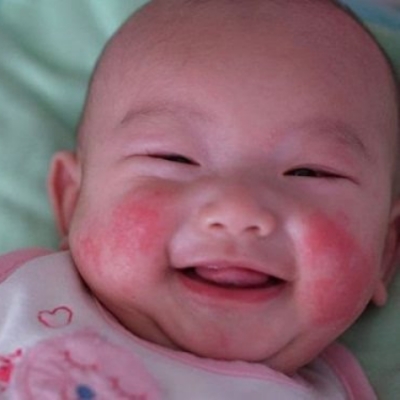 Bí quyết chữa nẻ mặt ở trẻ sơ sinh mùa đông mọi bà mẹ cần biết