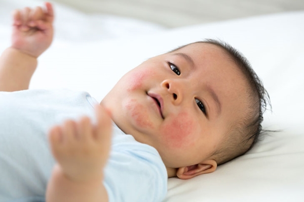 Tìm hiểu về dị ứng sữa ở trẻ sơ sinh