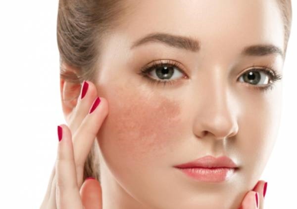 LIỆU TRÌNH TRỊ NÁM VÀ SÁNG DA