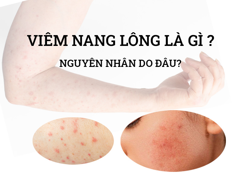 Viêm nang lông là gì? Nguyên nhân bị viêm nang lông mùa  Tết 