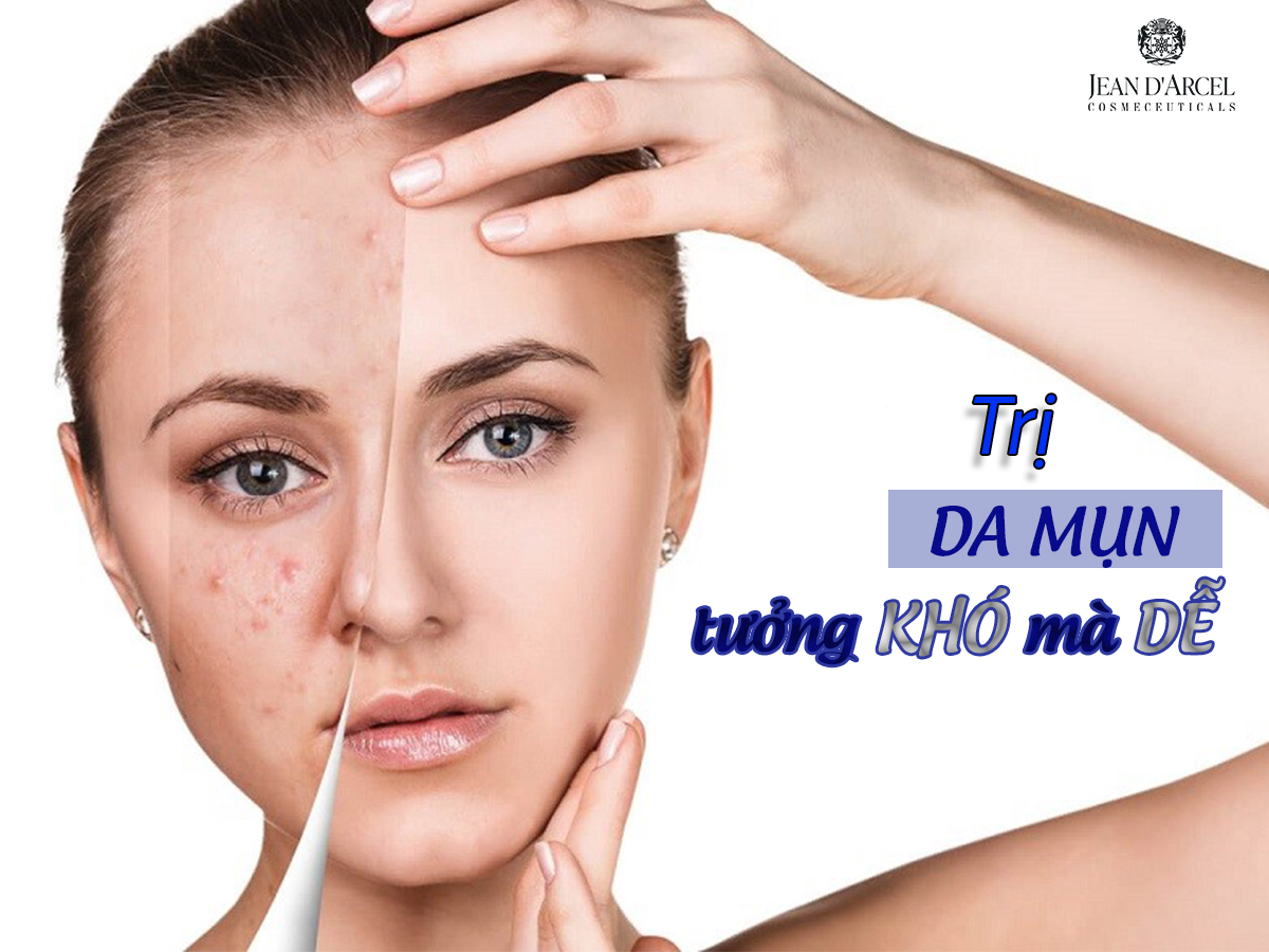 Giải Pháp Hoàn Hảo Cho Da Mụn