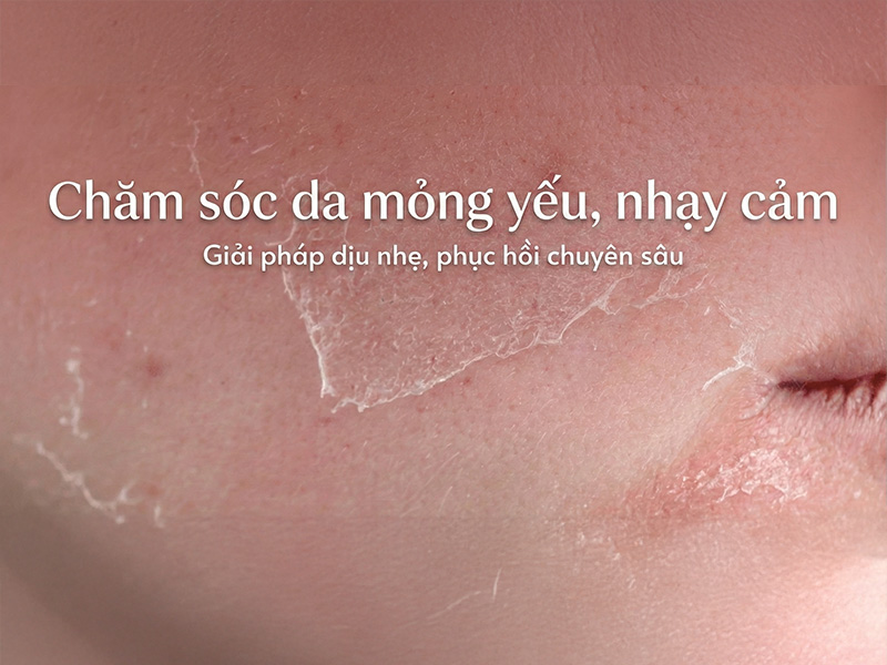 Chăm sóc da mỏng yếu, nhạy cảm: Quy trình phục hồi khoa học