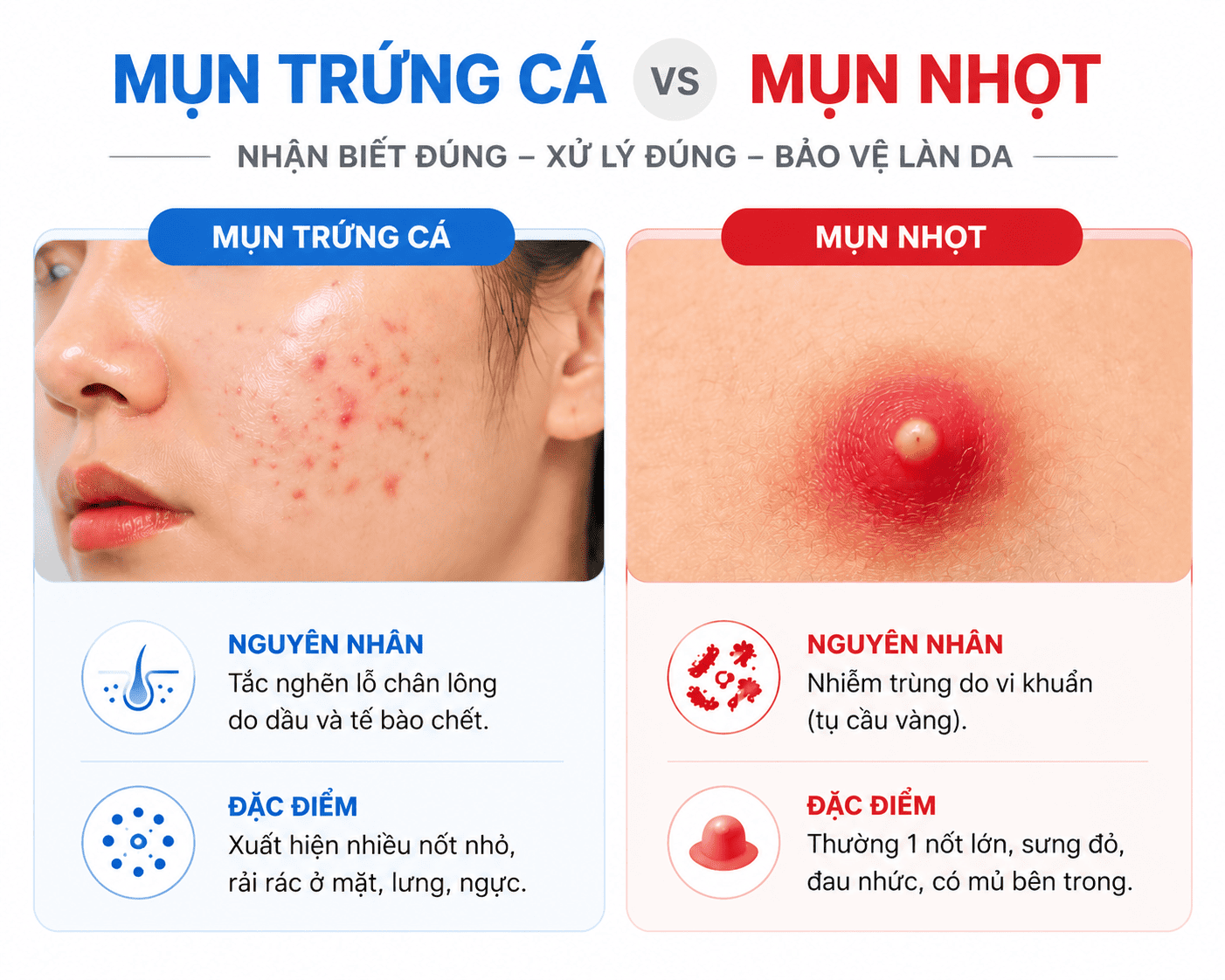 Phân Biệt Mụn Trứng Cá Và Mụn Nhọt: Cách Nhận Biết Và Xử Lý Chuẩn Y Khoa