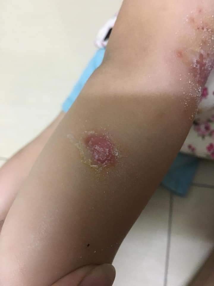Chốc lây ở trẻ em