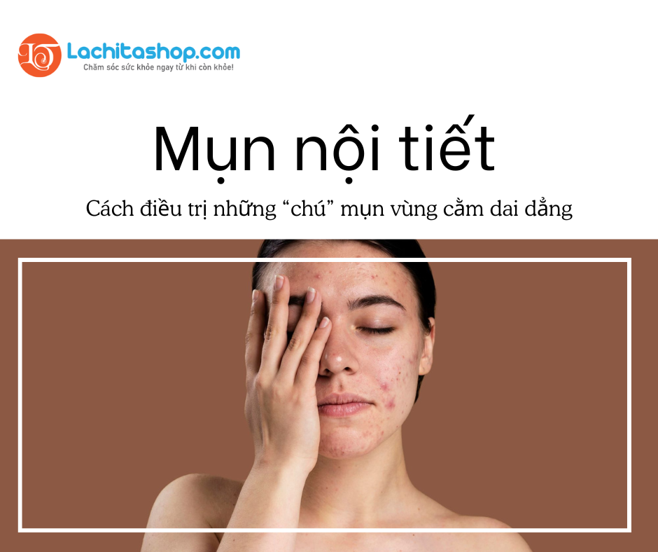 MỤN DO MẤT CÂN BẰNG NỘI TIẾT TỐ