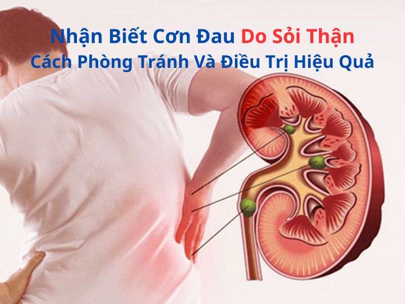 Nhận Biết Cơn Đau Do Sỏi Thận: Cách Phòng Tránh Và Điều Trị Hiệu Quả