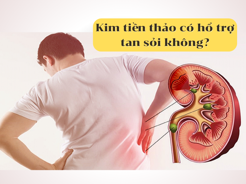 Cây kim tiền thảo có làm tan sỏi thận được không?