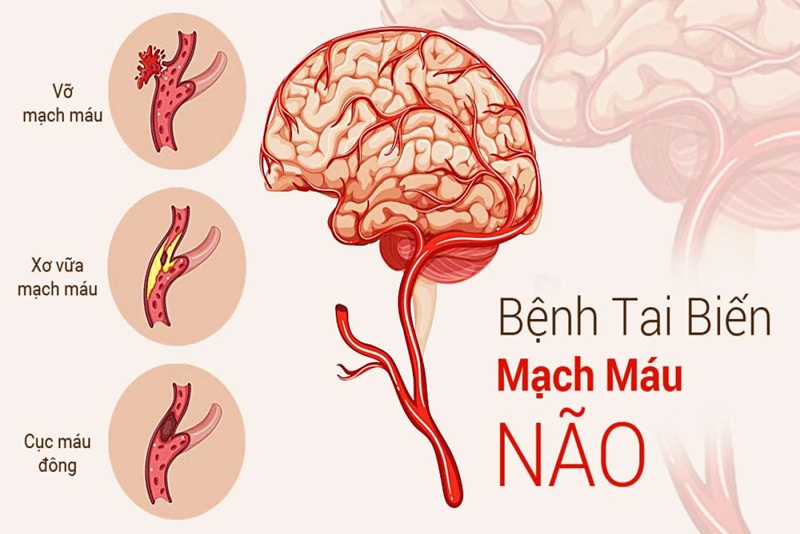 Bệnh tai biến mạch máu não do đâu?