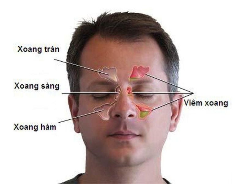 Viêm xoang sàng là gì?