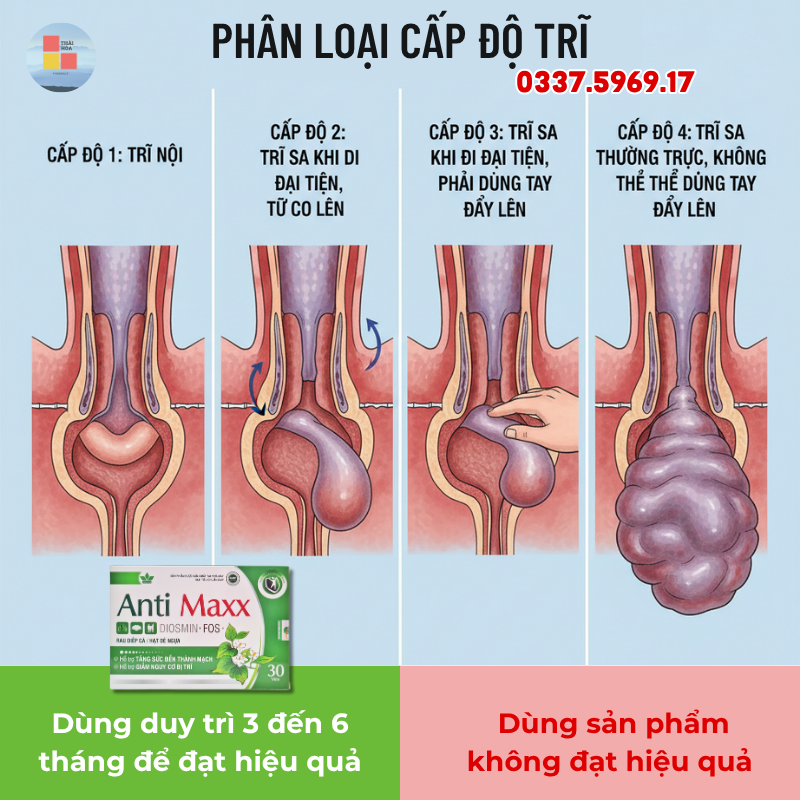 Antimax dùng phù hợp cho người trĩ độ 1 và trĩ độ 2