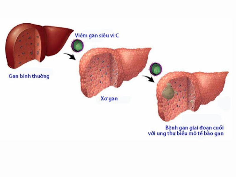 Dấu hiệu nhận biết gan nhiễm mỡ theo từng giai đoạn