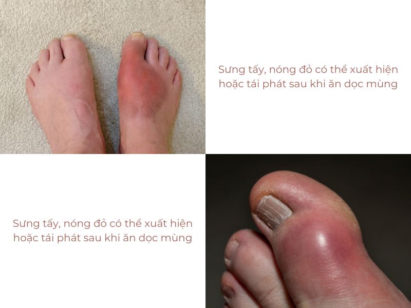Người bệnh gout ăn dọc mùng sẽ làm bệnh trở nặng hơn