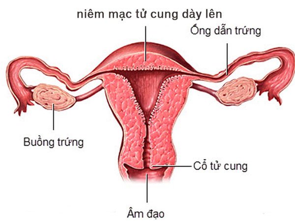 Niêm mạc tử cung lý tưởng để thụ thai