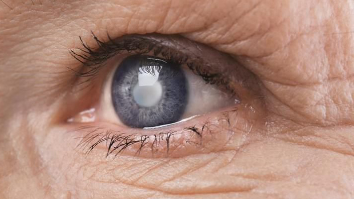 Triệu chứng đục thủy tinh thể là gì ?