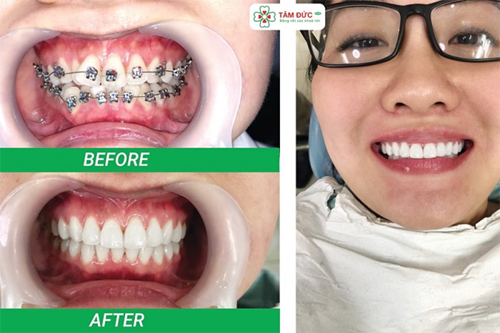 Danh sách các Địa chỉ niềng răng uy tín nhất Vũng Tàu, Bà Rịa Vũng Tàu