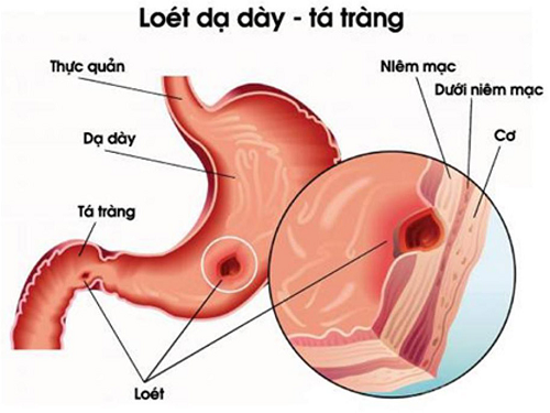 Tìm hiểu về bệnh viêm loét dạ dày tá tràng