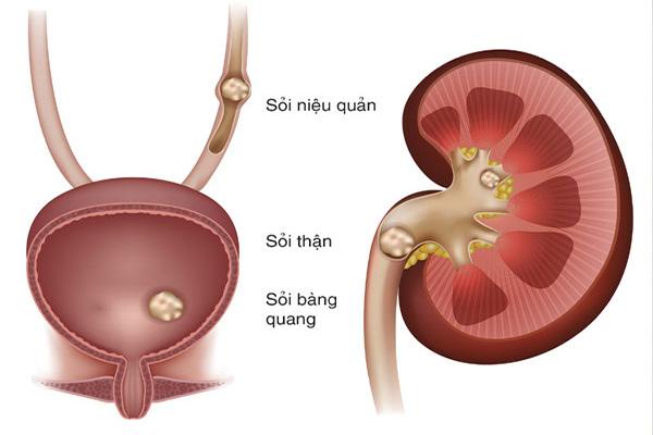 Những nguyên nhân gây sỏi thận không ngờ