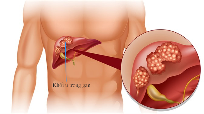 Những nguyên nhân gây ung thư gan