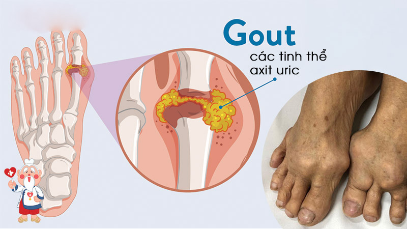 Gout là bệnh viêm khớp do tinh thể urate gây ra