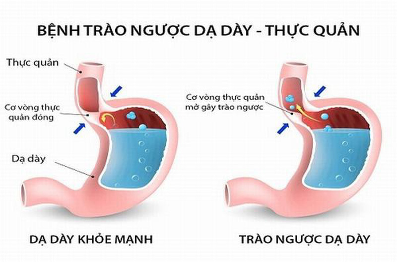 Trào ngược dạ dày thực quản và cách phòng ngừa Phòng khám Đông y Phúc Thành