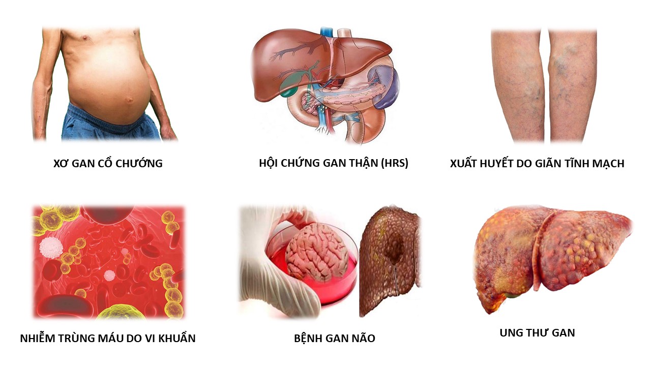 Biến chứng nguy hiểm của bệnh viêm gan B