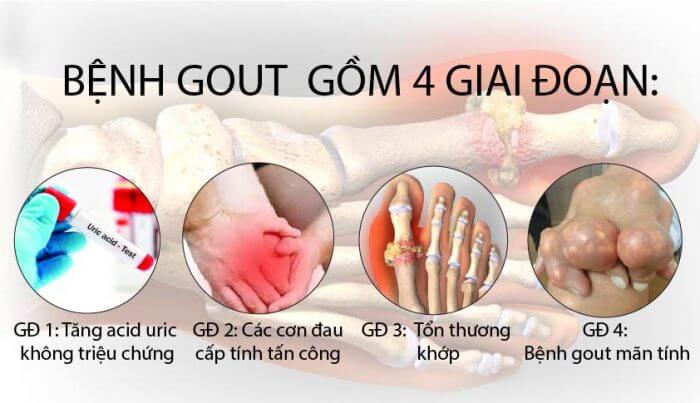 Các giai đoạn phát triển của bệnh Gout