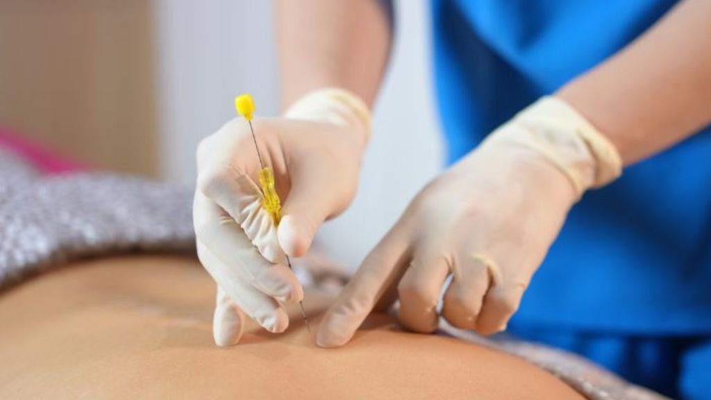 Cấy chỉ là phương pháp Đông y hiện đại giúp điều trị thể hàn hiệu quả nhờ khả năng kích thích huyệt kéo dài, bổ dương khí, tán hàn và điều hòa khí huyết.