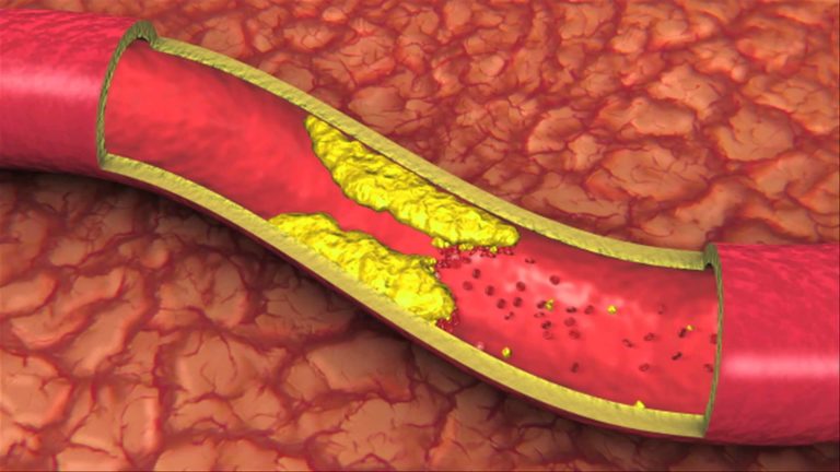 Cholesterol xấu tạo ra mảng bám và làm hẹp mạch máu