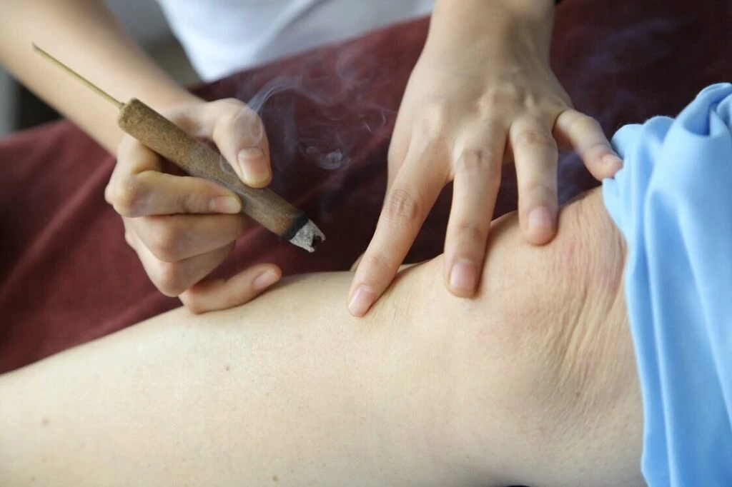 Cứu điếu ngải: tay thầy thuốc cầm điếu ngải hơ trên huyệt đạo của người bệnh
