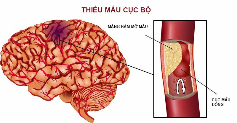 Cục máu đông là nguyên nhân hàng đầu gây đột quỵ não với tỷ lệ 80%